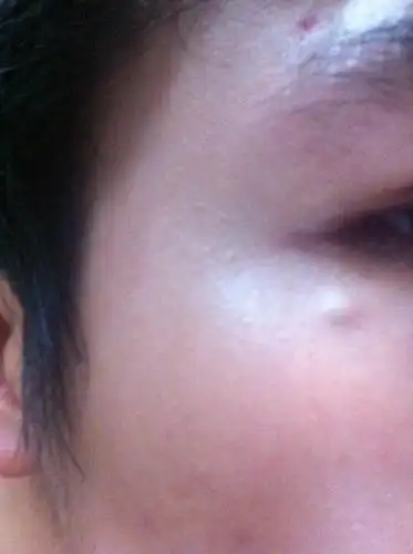 眼睛边长这个包很久了,硬硬的,按着不疼,请问怎么治呢