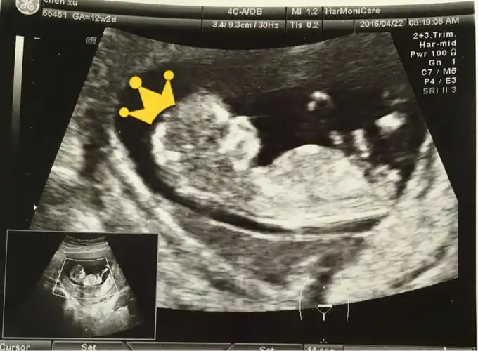 nt图弯着就是男孩,平是女孩nt躺着的女孩居多-爱子网