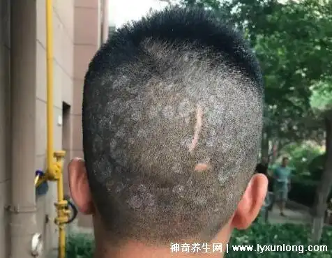 头皮癣症状图片黄癣脓癣黑点癣灰斑癣小心永久性脱发