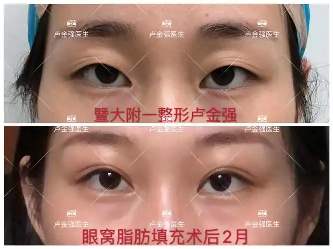 眼窝凹陷脂肪填充案例