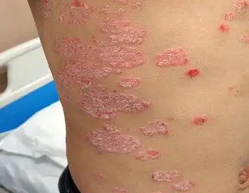 牛皮肤癣初期的症状图片_银屑病求医网