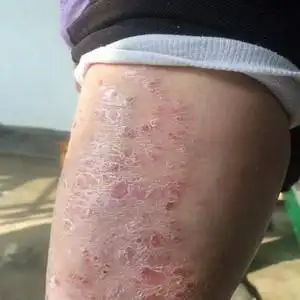 湿疹癣药膏外用癣根除正品股藓膏杀菌私处皮肤大腿内侧瘙痒止痒王