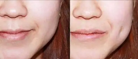 小酒窝小梨涡怎么分,想要后天拥有,医美可以做出来吗?