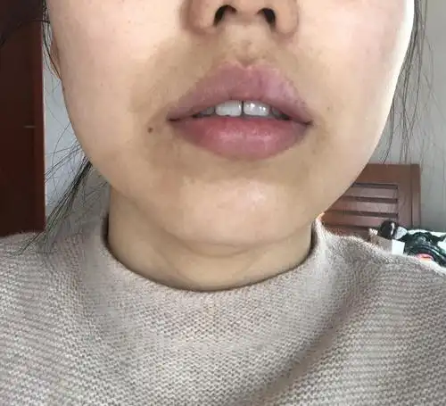 下巴暗沉是怎么回事?求指导.