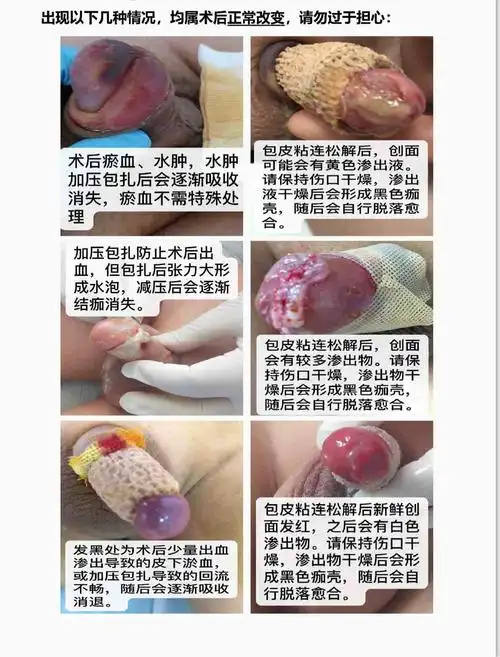 在青少年期,最好也能清楚的告知男孩本人,最好等他们能明白割包皮的