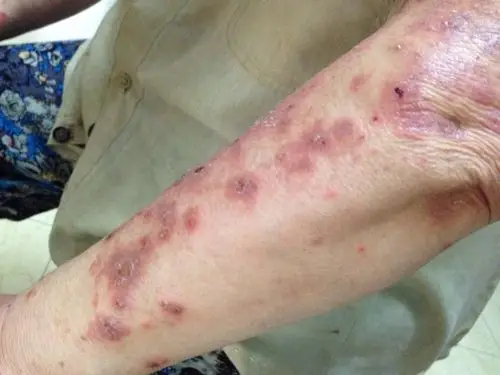 老人身上起了湿疹,非常厉害,中药也吃了一年多了,基本没用,各种药品都
