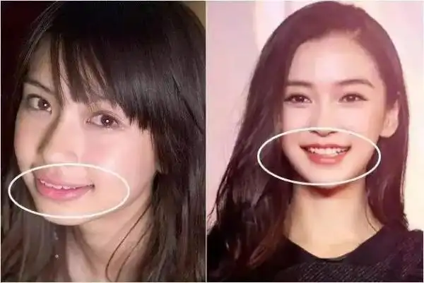 想不到美女也有牙齿的烦恼仔细观看整牙前后对比图,angelababy在整牙