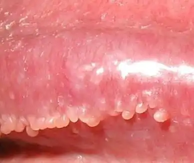 病例讨论阴茎珍珠样丘疹