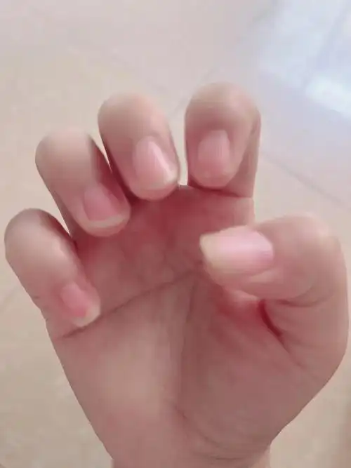 这么短的指甲还有救吗?