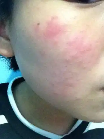 皮肤发痒,一大片红疙瘩的豆一样,是不是过敏该怎么办?