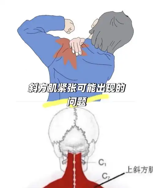 斜方肌紧张可能出现的问题