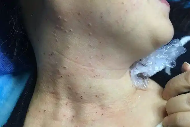 女性脖子扁平疣图片