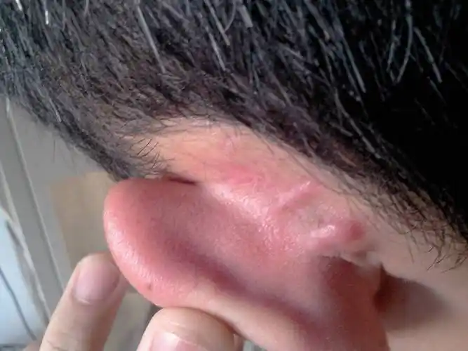 耳后的齐胎瘤切除后怎么感觉又长了?