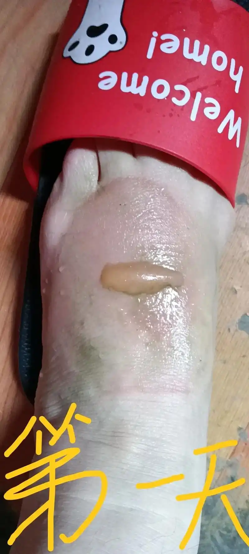 这是我5月30号中午,被一个朋友刚打的开水不小心烫了脚,中间 - 抖音