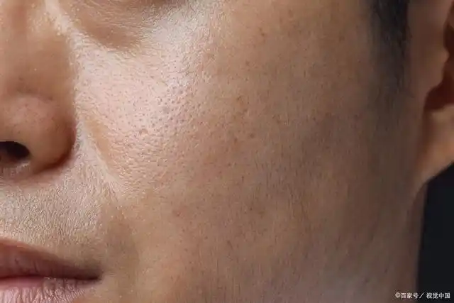 毛孔粗大怎么办?这条快点码住!