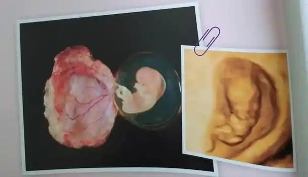 脆弱又坚强的"小豌豆"┃新生命的第2个月