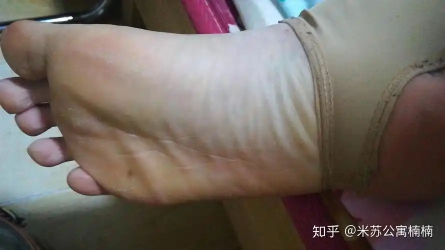 汗脚求救,女生脚气脚臭怎么办! - 知乎