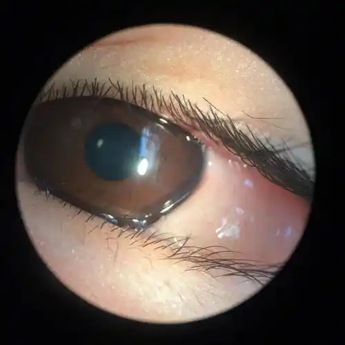 救我!我想把眼珠子抠出来!"入春后,你中招了吗?_杭州_过敏性_症状