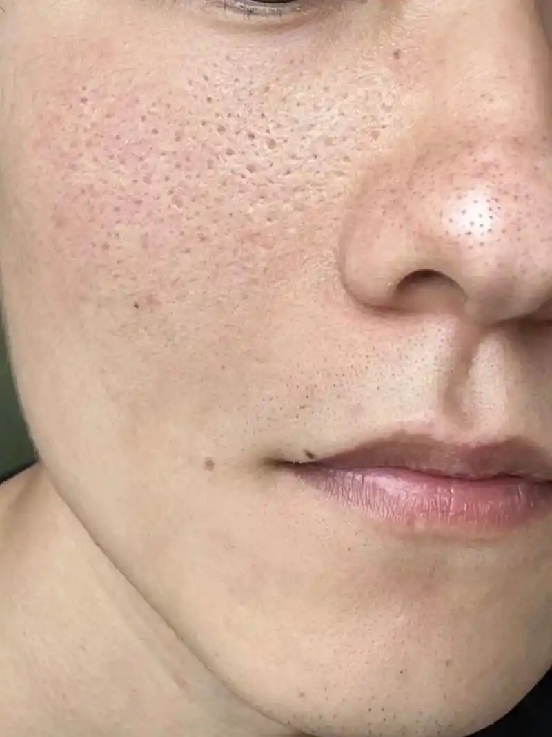 坚持收缩毛孔的第39天!成功上岸.#男生皮肤油千万别不当回事 - 抖音