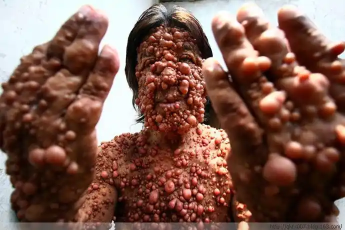 印尼男子全身疯长恐怖肿瘤