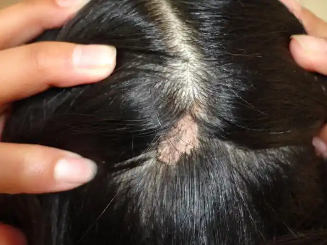 头皮上长的是什么