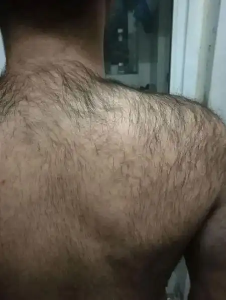 男生腿毛浓密怎么办?