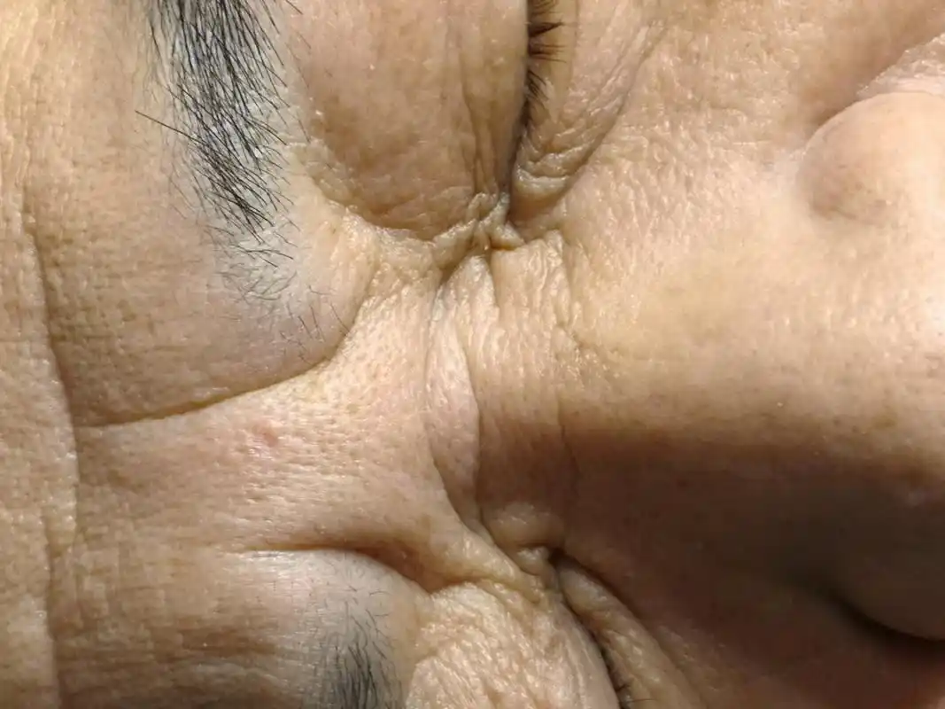 鼻根横纹#皱纹#