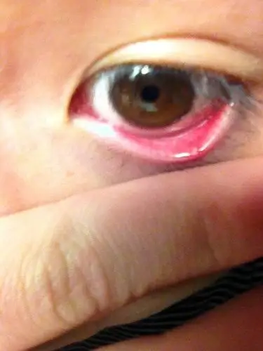 33提问者:_做个乖乖仔∨ 满意回答  今天 08:48 怀疑是沙眼或结膜炎