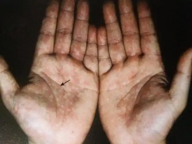 风水玄学  手相掌纹 肝区掌色的改变与肿瘤有什么特殊关系肝区掌色的