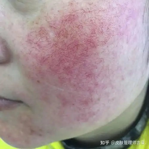 敏感皮肤咋形成? - 知乎