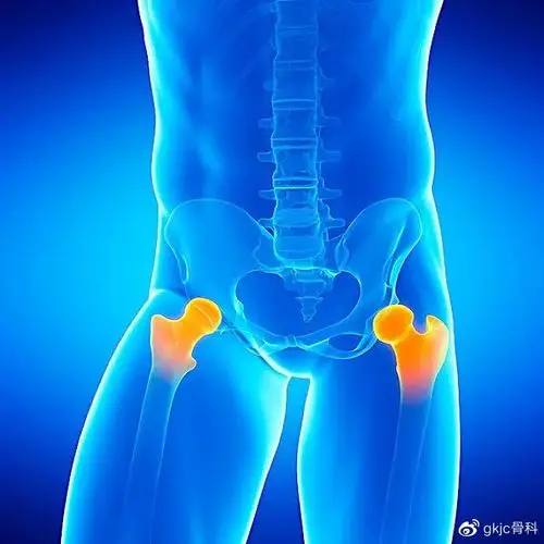 股骨头坏死三期了,多久会瘫痪?