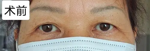 中老年上眼睑皮肤松弛矫正 - 好大夫在线