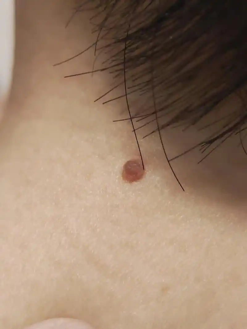 健康美好生活计划# 孕28周,背部,私处增生小肉瘤.