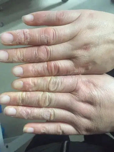 我爸的手生了癣,都不知道生的什么 平时手多痒,每根指母都有 还要裂开