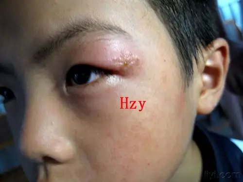 左上眼睑的皮损已不是第一次发生了