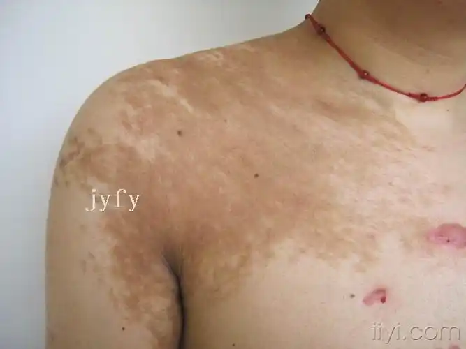 色素性毛表皮痣