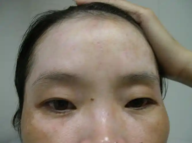 白癜风照片(2) - 好大夫在线