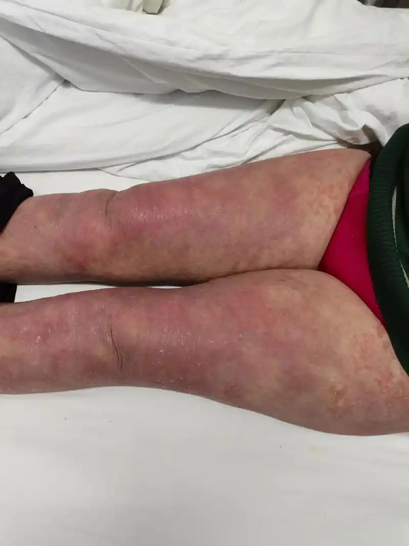 会诊多个皮肤病!一个红皮型银屑病(牛皮癣),3个泛发性湿疹, - 抖音