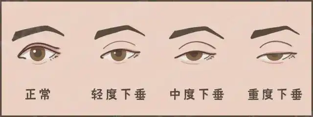 不是"睡不醒",而是"上睑下垂"这种病|眼病|外伤|双眼皮手术|眼睑_网易