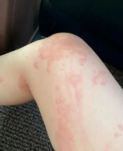 荨麻疹没有反复的第十三个月_蚊子_原因_疙瘩