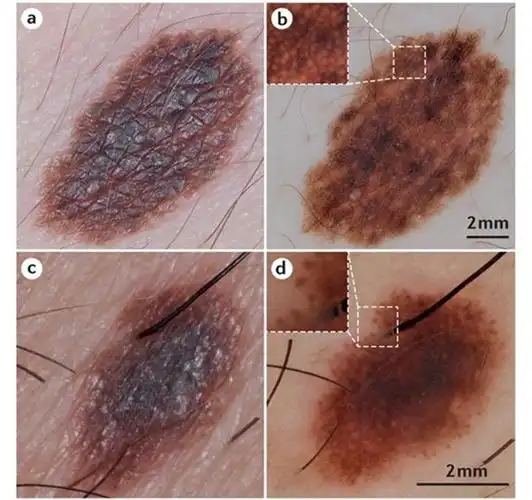 以下是色素痣和早期黑色素瘤在皮肤镜下的表现.