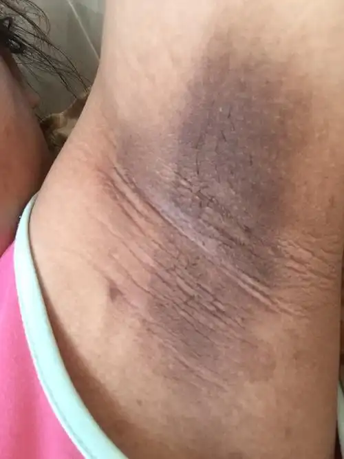 怀孕身体部位变黑