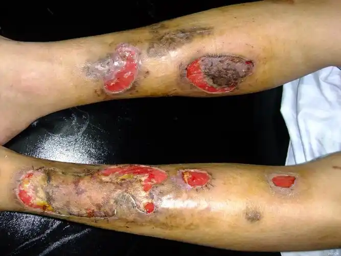 【讨论】一例难愈性双侧小腿溃疡,已住院一个月,急求各位大虾支招