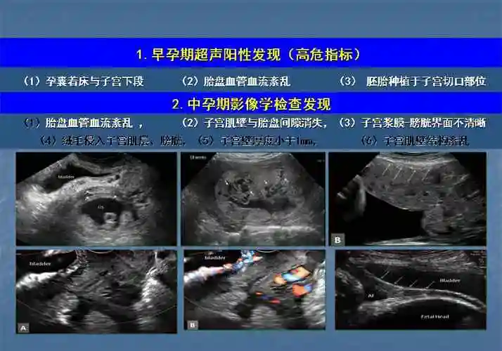 胎盘植入诊治指南ppt课件.ppt_第3页