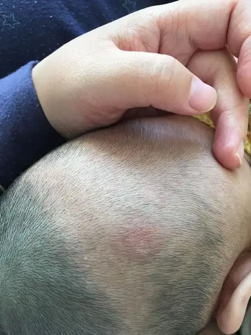 4个月婴儿后脑勺枕秃的地方长了廯斑怎么办