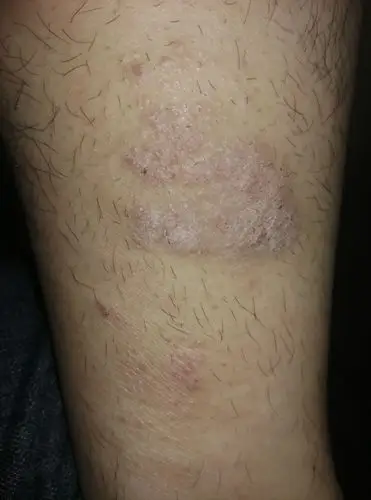 小腿接近脚踝附近的皮肤有一块凸起瘙痒掉皮屑最开始是毛孔有颗