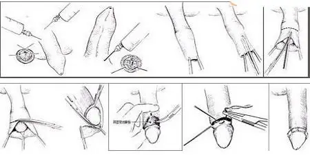 贵阳包皮手术过程