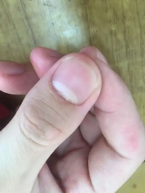 指甲根部开裂,什么问题