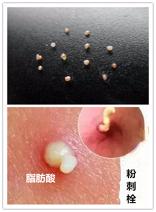 教你区别脂肪粒和痘痘