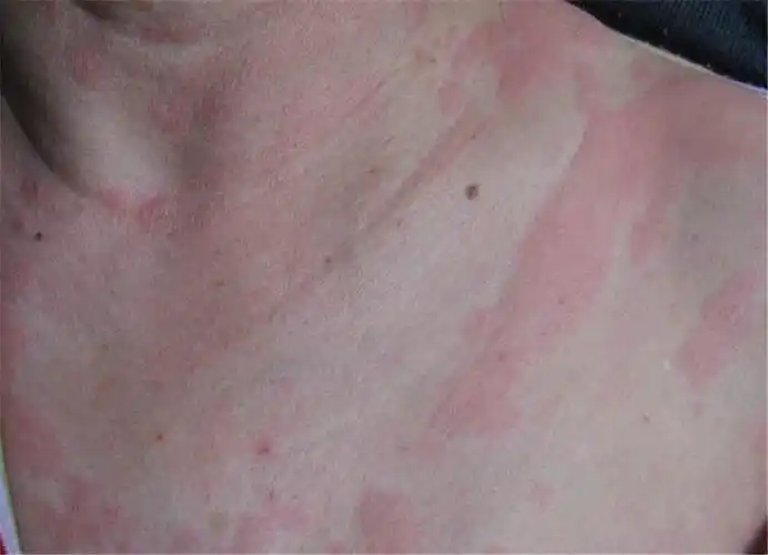 寒冷性荨麻疹手背皮肤病图片